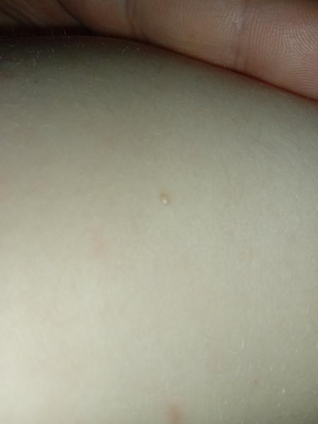 Mohou být růžové fleky příznakem neštovic?