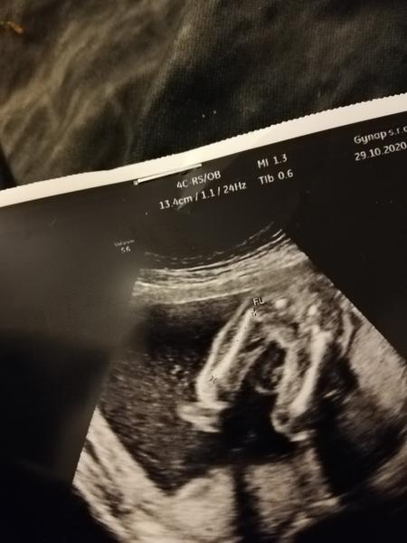 Poznáte podle ultrazvuku pohlaví?