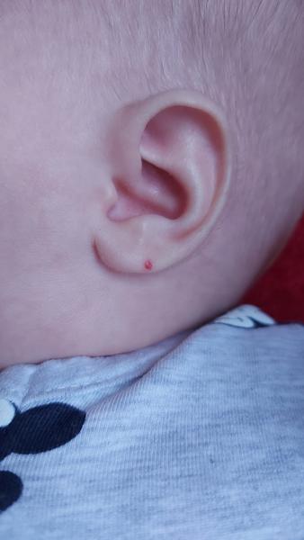 Červené znaménko u tříleté dcery. Co může znamenat?