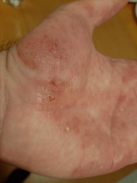 Dishydrotický ekzém. Co by mohlo pomoci v léčbě?