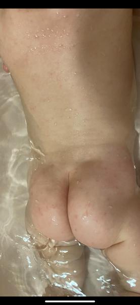 Vyrážka. Je možná alergická rekace na bio dětský čaj?