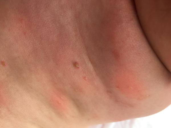 Boláky pod krkem. Zkušenosti? Prosím, pomůžete?