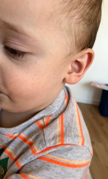 Zuby u dětí a flíčky na obličeji. Jak souvisí?