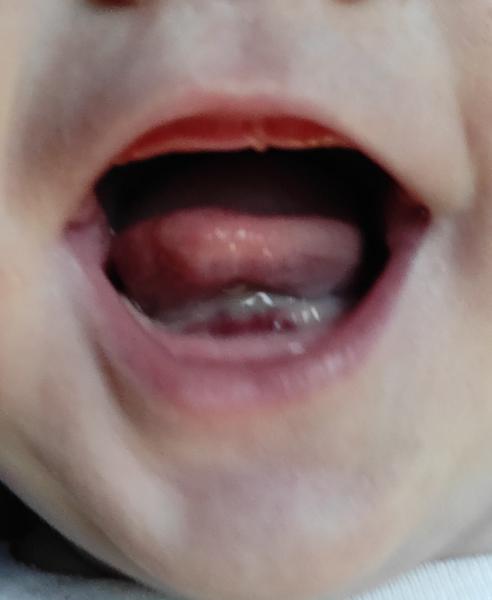 Červený flíček u miminka pod jazykem: Příčina a řešení?