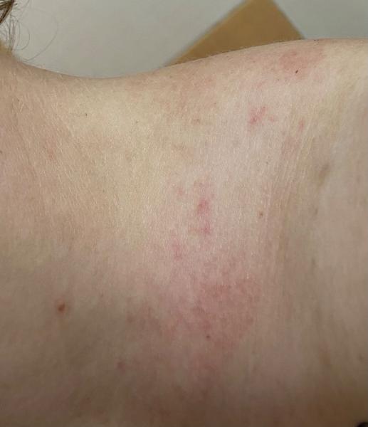 Je to ekzém nebo svrab? Rozpoznání a rady.