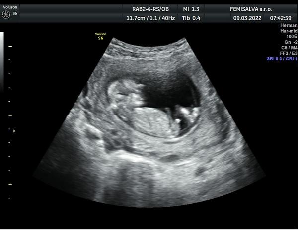 Screening pohlaví dítěte. Jaké máte zkušenosti a názory?