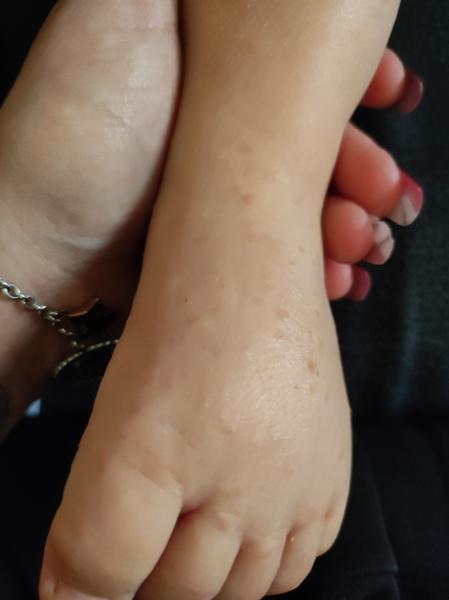 Pupínky od 4. měsíce. Co to může být?