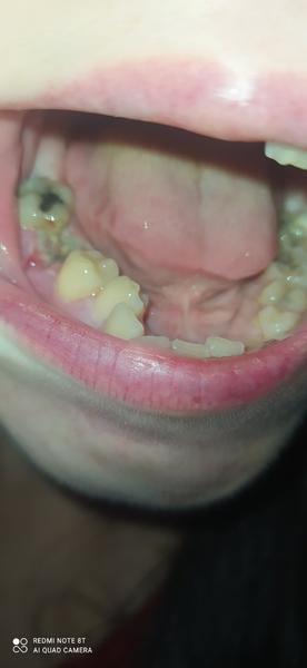 Co znamená šedivý povlak po extrakci zubu?