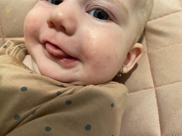 Je to alergie nebo ekzém?