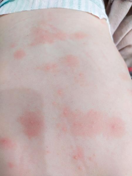 Má někdo představu, co je to za vyrážku?