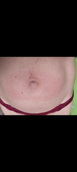 Je to erythema migrans nebo kvasinková infekce?