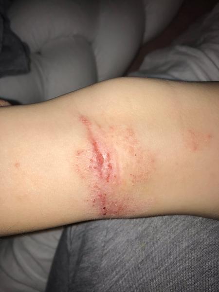 Ekzém, dcerka 3,5 roku. Je kvasinkový?