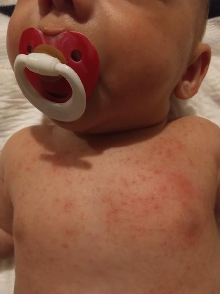 Máte zkušenost s vyrážkou na rukou a zádech?