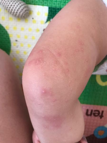 Vyrážka na nozičkách ročního chlapečka. O jakou vyrážku by se mohlo jednat?