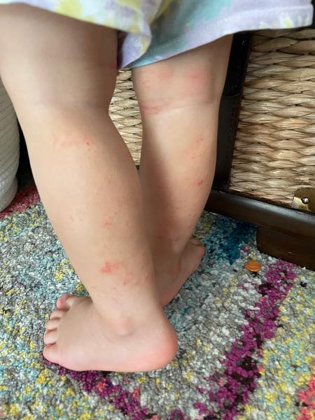 Příčiny nespavosti u 17měsíčního dítěte: ekzém nebo zuby?