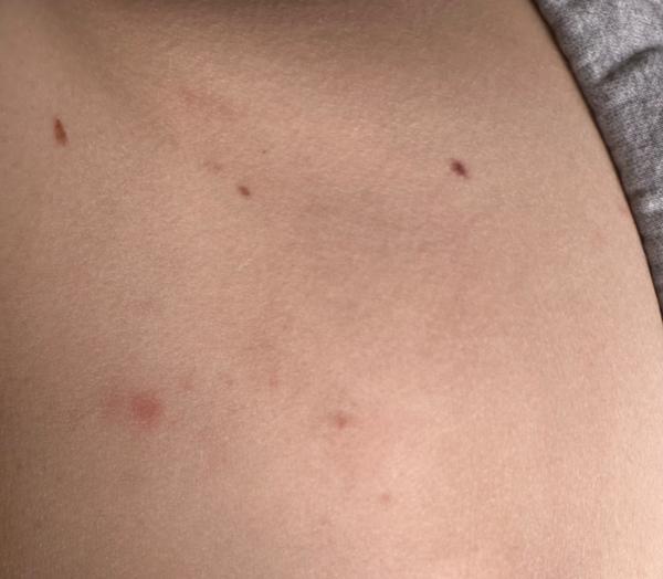 Červené fleky na břiše. Jak řešit jejich příčinu?