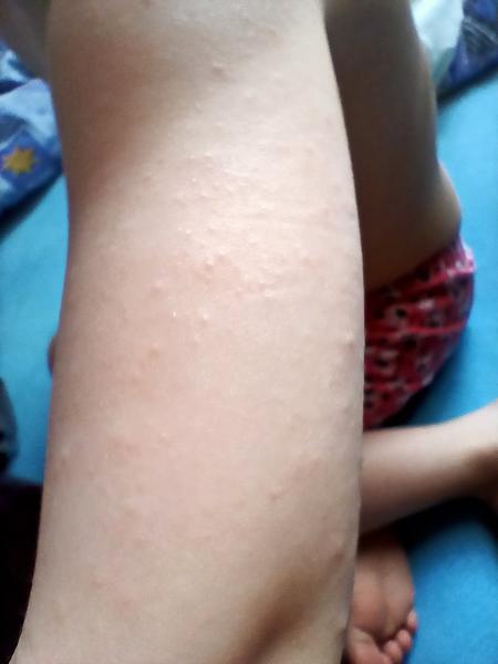 Vyrážka na obličeji a krupička po těle. Co si o tom myslíte?