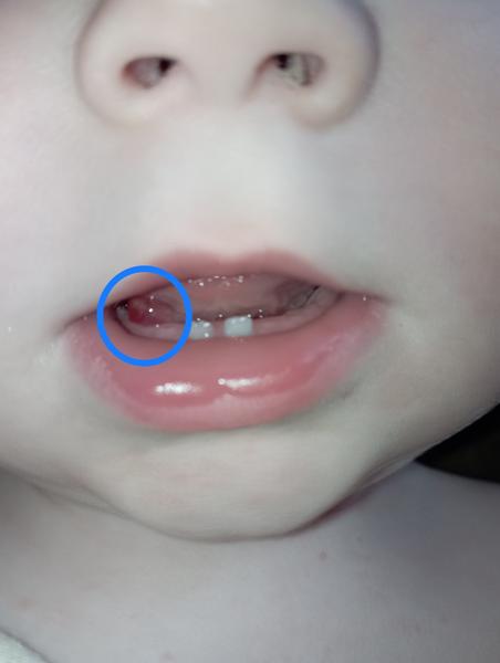 Výrůstek v ústech: Máte stejné zkušenosti?