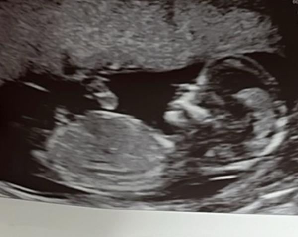 Pohlaví ve 13. týdnu těhotenství: Kluk nebo holka?