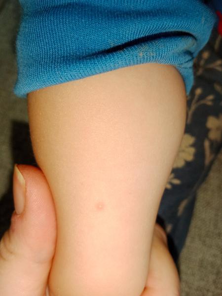 Pupínky. Je možné, že jsou to neštovice?