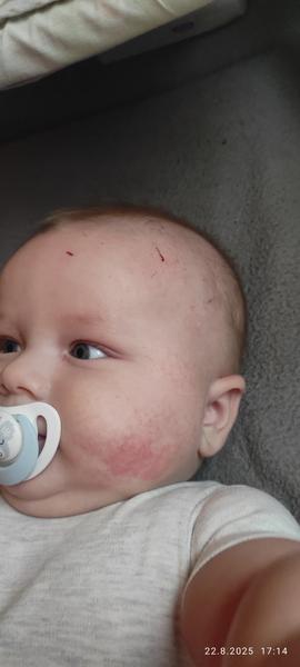 Jak pomoci miminku s vyrážkou a ekzémem?