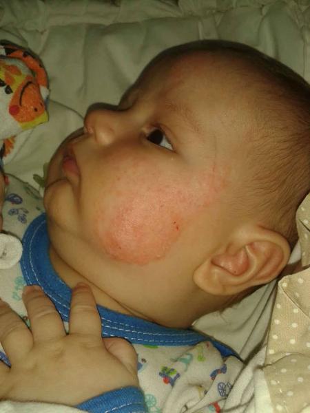 Exémek na tvářích a čele