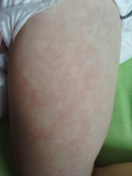 Zkušenosti s léčbou vyrážky. Co pomohlo vám?