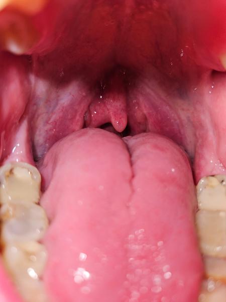 Co způsobuje bolest v krku při polykání?