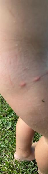 Jak léčit štípance od sametky či svilušky u dětí?