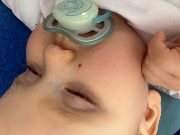 Krvavý výrůstek na tváři dcery. Co by to mohlo být?