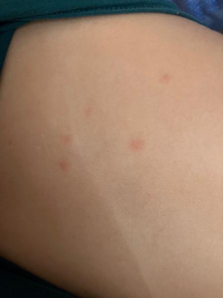 Červené flíčky. Mohou být z Nurofenu?