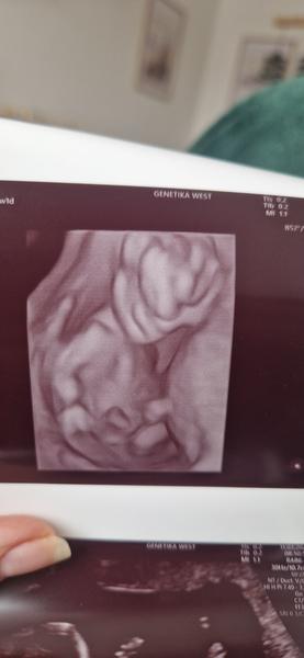 Pohlaví dítěte podle ultrazvuku. Co tipujete?