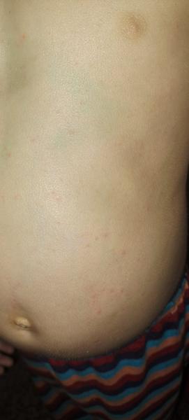 Možné příčiny svědivé vyrážky u dvouletého dítěte