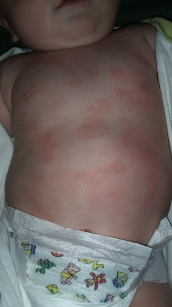 Vyrážka po mrkvi, máte zkušenost?