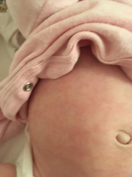 Vyrážka u 3měsíčního miminka