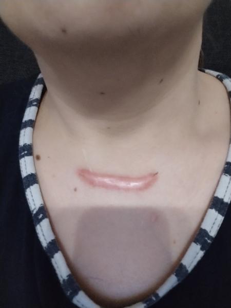 Laserové ošetření koloidní jizvy v Olomouci. Kolik stojí?