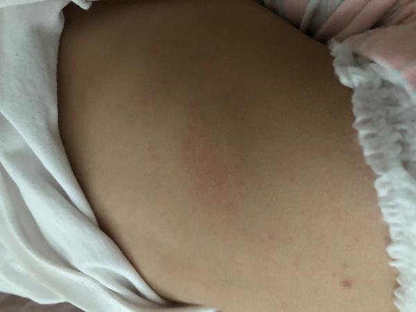 Ekzém, potničky, nebo zapařenina. Co myslíte?