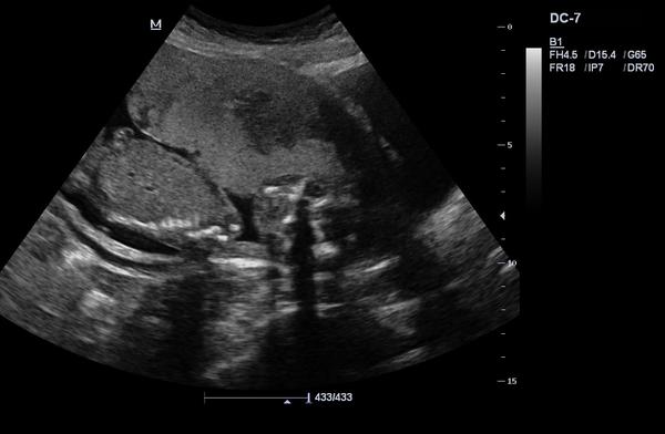 Znáte metody určování pohlaví miminka podle ultrazvuku?