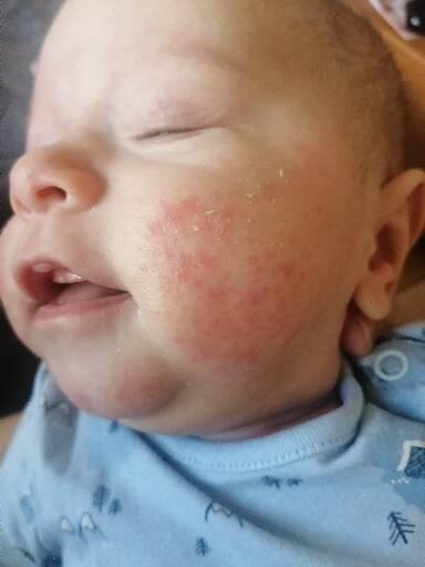 Kvasinka nebo atopický ekzém? Jak léčit?