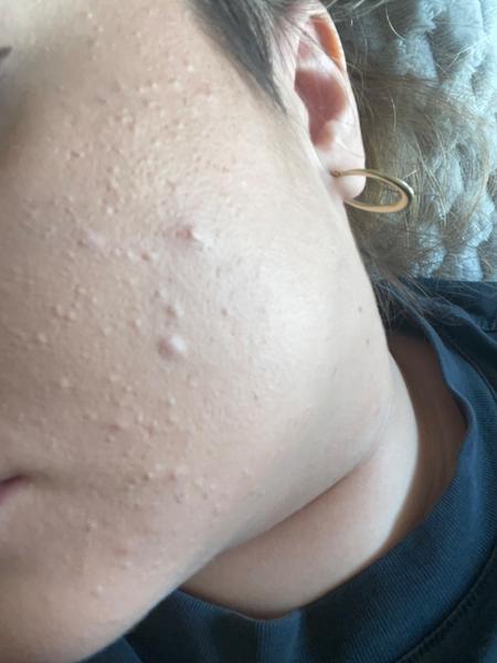 Tipy pro ucpané póry a akné při použití make-upu