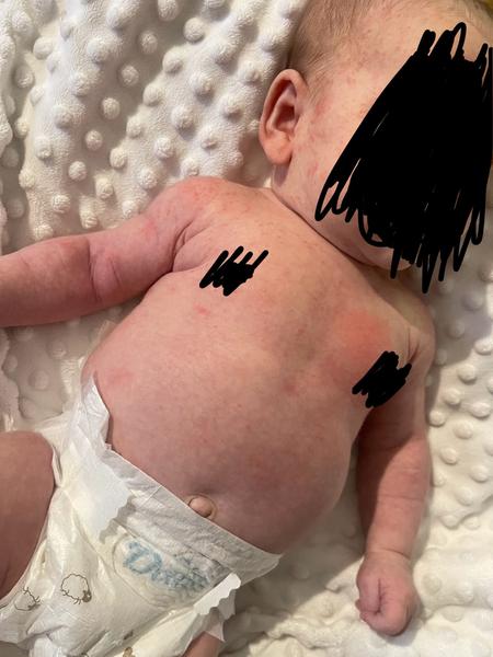 Červené flíčky po těle. Jde o novorozenecké akné?