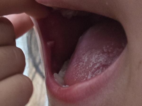 Horečky u dítěte s bolestí v ústech. Zkušenosti?