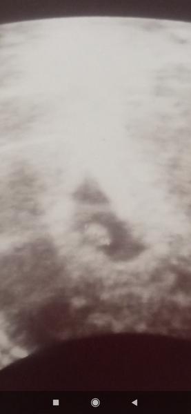 Je na ultrazvuku v 6. týdnu jedno nebo dvě miminka?