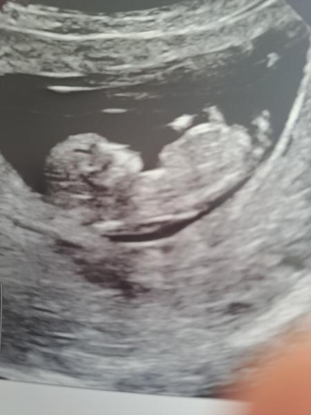 Prvotrimestrální screening v zahraničí. Je nedostačující?