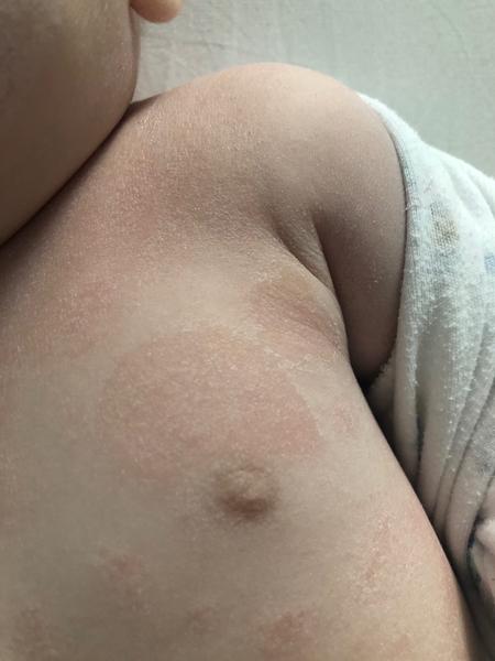 Ekzém nebo kvasinka. Jak a čím pokračovat v léčbě?