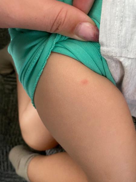 Červené fleky na kůži dítěte. Co to může být?