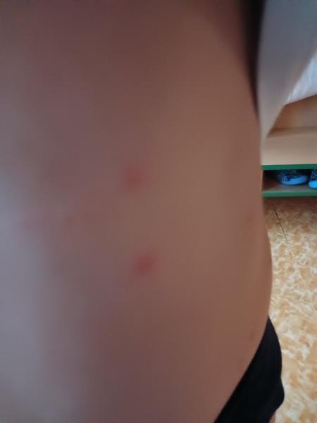 Co způsobuje svědící vyrážku na trupu a nohách?