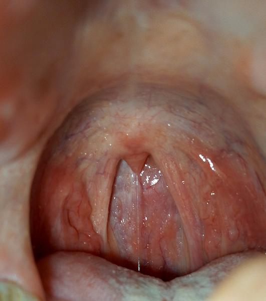 Je bolest v krku bez teploty normální?