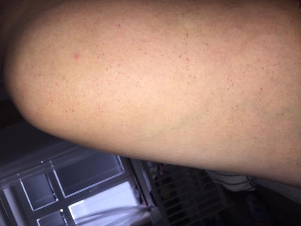 Fleky na stehnech. Co by to mohlo být?