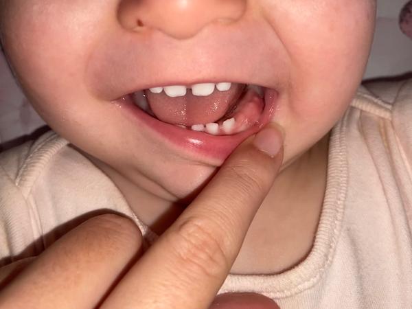 Mohou být bílé skvrny v ústech zoubky nebo aft?